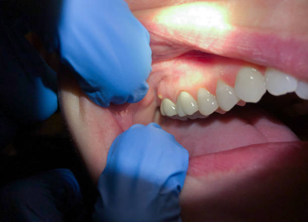 Best Emergency Care for Gum Disease in Solomons, MD